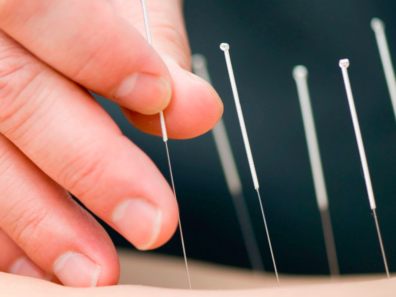Conheça mais sobre acupuntura