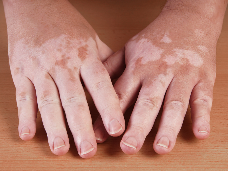 Vitiligo: O que é, causas e tratamentos